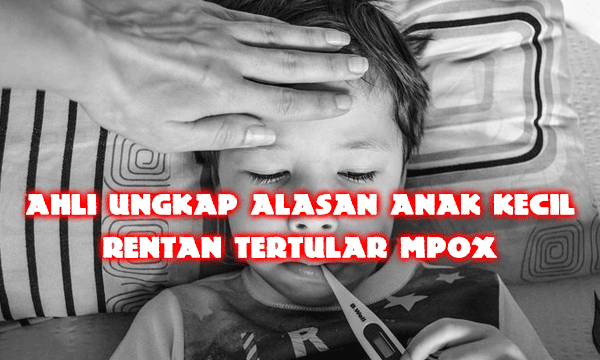 Ahli Ungkap Alasan Anak Kecil Rentan Tertular Mpox